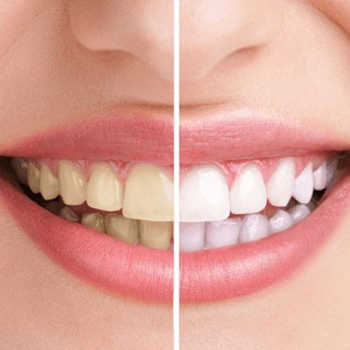 Whitening Toothpaste Manufacturer in India by HCP Wellness